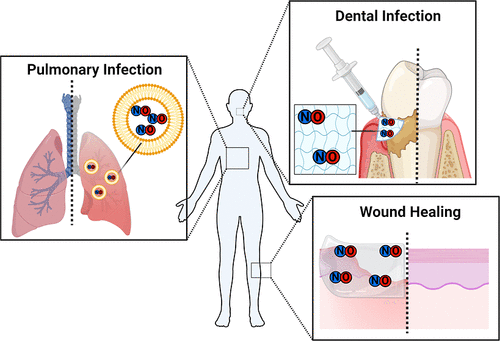 Nitric Oxide-Releasing Therapeutics for Treating Bacterial Infections: Anatomical Targeting and Therapeutic Design